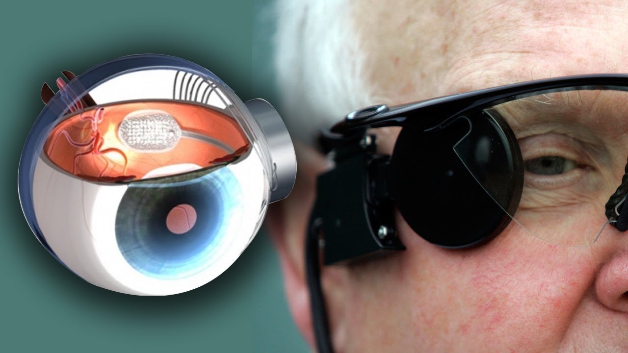 Cấy ghép mắt công nghệ "Mắt Bionic" cho người khiếm thị